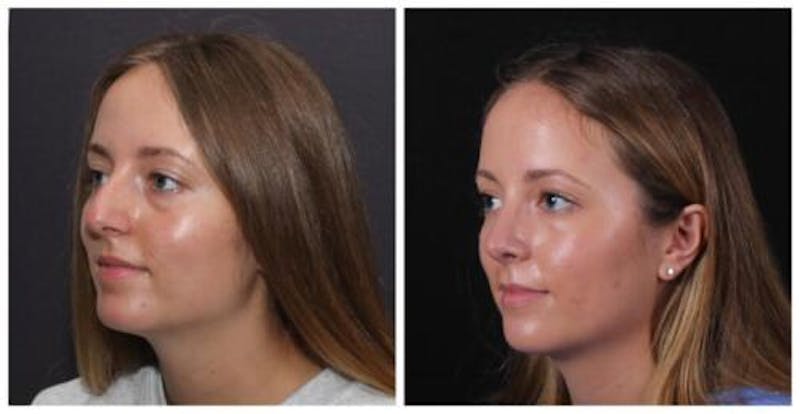 Rhinoplasty Before & After Gallery - Patient 353078 - Image 5