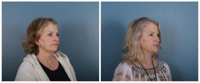 Face and Neck Lift Before & After Gallery - Patient 246788 - Image 2