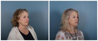 Face and Neck Lift Before & After Gallery - Patient 246788 - Image 2