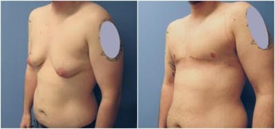 FTM Mastectomy Before & After Gallery - Patient 324189 - Image 2