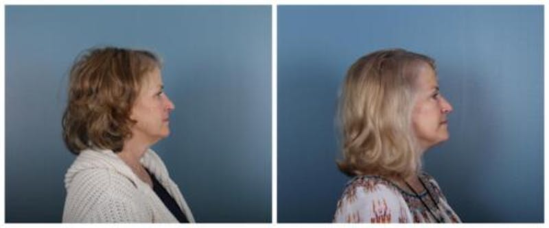 Face and Neck Lift Before & After Gallery - Patient 246788 - Image 3