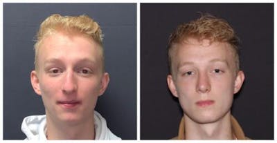 Rhinoplasty Before & After Gallery - Patient 199085 - Image 1