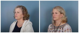 Face and Neck Lift Before & After Gallery - Patient 246788 - Image 4