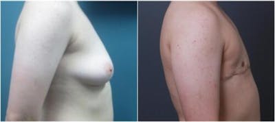 FTM Mastectomy Before & After Gallery - Patient 404587 - Image 1