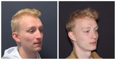 Rhinoplasty Before & After Gallery - Patient 199085 - Image 2