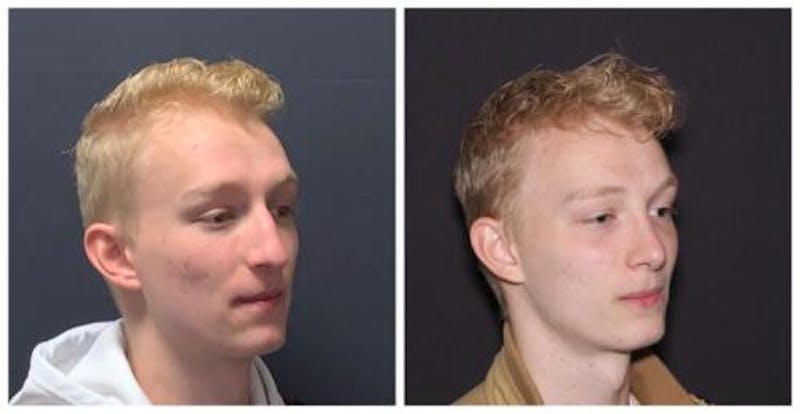 Rhinoplasty Before & After Gallery - Patient 199085 - Image 2