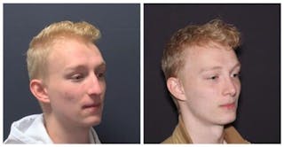 Rhinoplasty Before & After Gallery - Patient 199085 - Image 2