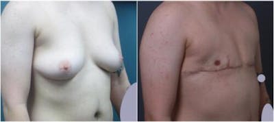 FTM Mastectomy Before & After Gallery - Patient 404587 - Image 2