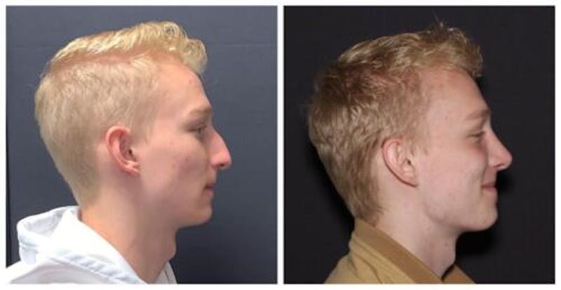 Rhinoplasty Before & After Gallery - Patient 199085 - Image 3