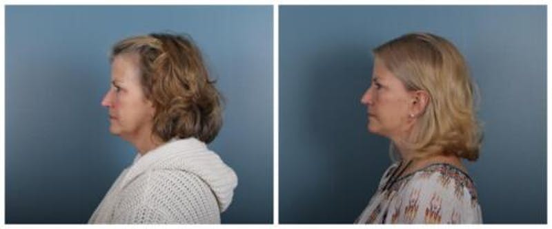 Face and Neck Lift Before & After Gallery - Patient 246788 - Image 5