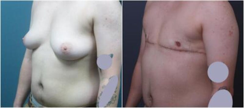 FTM Mastectomy Before & After Gallery - Patient 404587 - Image 3