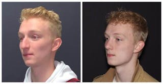 Rhinoplasty Before & After Gallery - Patient 199085 - Image 4