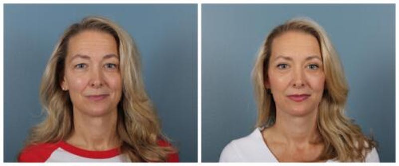Face and Neck Lift Before & After Gallery - Patient 611339 - Image 1