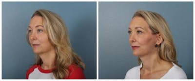 Face and Neck Lift Before & After Gallery - Patient 611339 - Image 2