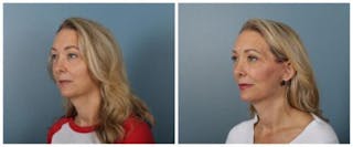 Face and Neck Lift Before & After Gallery - Patient 611339 - Image 2