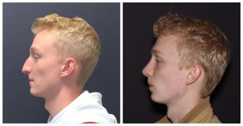 Rhinoplasty Before & After Gallery - Patient 199085 - Image 5