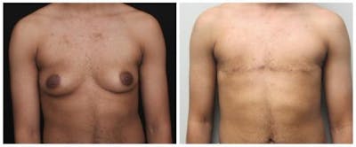 FTM Mastectomy Before & After Gallery - Patient 103688 - Image 1