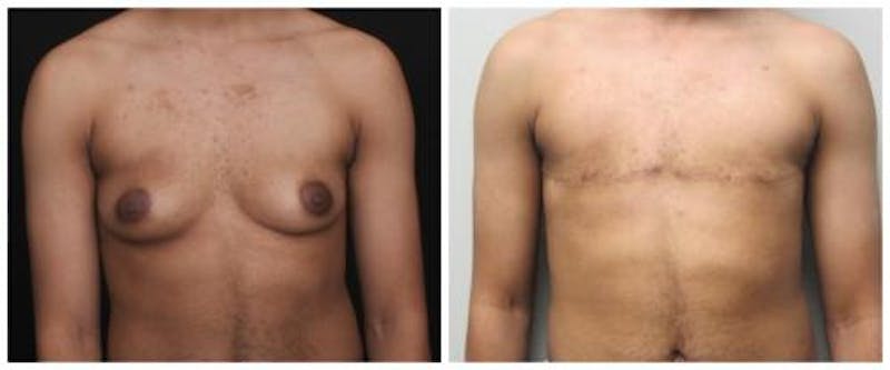FTM Mastectomy Before & After Gallery - Patient 103688 - Image 1