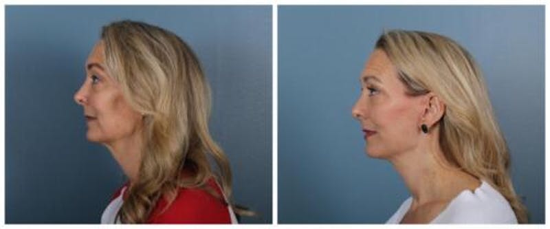 Face and Neck Lift Before & After Gallery - Patient 611339 - Image 3
