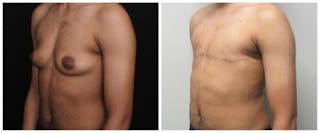 FTM Mastectomy Before & After Gallery - Patient 103688 - Image 2