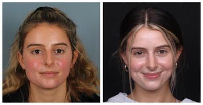 Rhinoplasty Before & After Gallery - Patient 699860 - Image 1