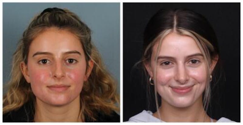 Rhinoplasty Before & After Gallery - Patient 699860 - Image 1