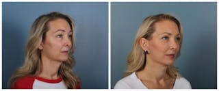 Face and Neck Lift Before & After Gallery - Patient 611339 - Image 4
