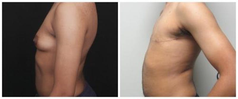 FTM Mastectomy Before & After Gallery - Patient 103688 - Image 3
