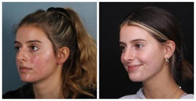 Rhinoplasty Before & After Gallery - Patient 699860 - Image 2