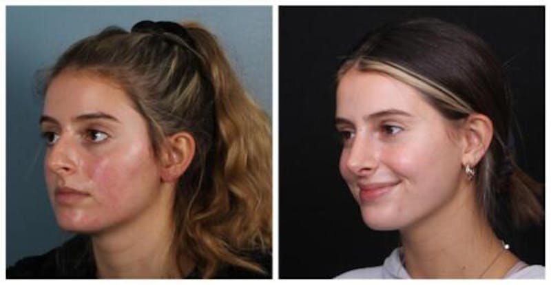 Rhinoplasty Before & After Gallery - Patient 699860 - Image 2