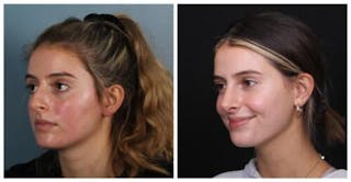 Rhinoplasty Before & After Gallery - Patient 699860 - Image 2