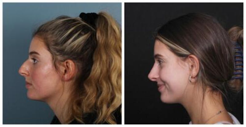 Rhinoplasty Before & After Gallery - Patient 699860 - Image 3