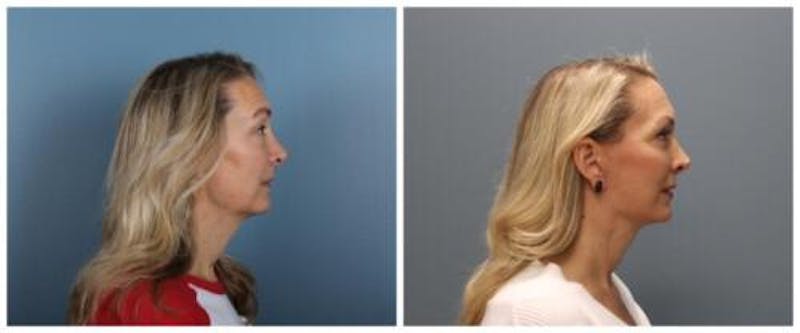 Face and Neck Lift Before & After Gallery - Patient 611339 - Image 5
