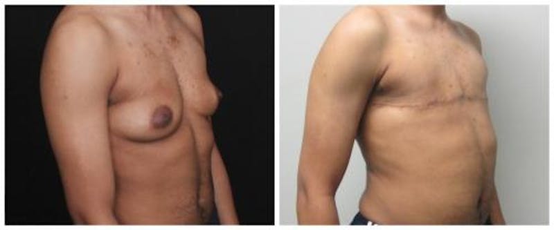 FTM Mastectomy Before & After Gallery - Patient 103688 - Image 4