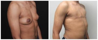 FTM Mastectomy Before & After Gallery - Patient 103688 - Image 4