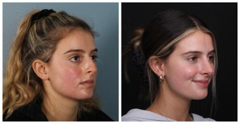 Rhinoplasty Before & After Gallery - Patient 699860 - Image 4