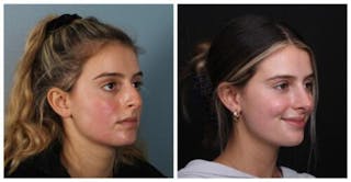 Rhinoplasty Before & After Gallery - Patient 699860 - Image 4