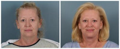Face and Neck Lift Before & After Gallery - Patient 329341 - Image 1
