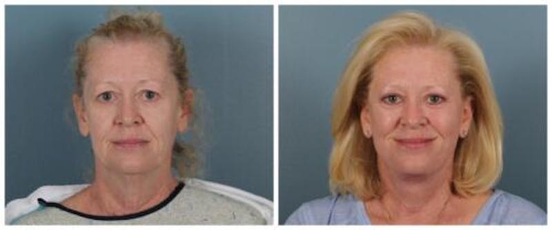 Face and Neck Lift Before & After Gallery - Patient 329341 - Image 1