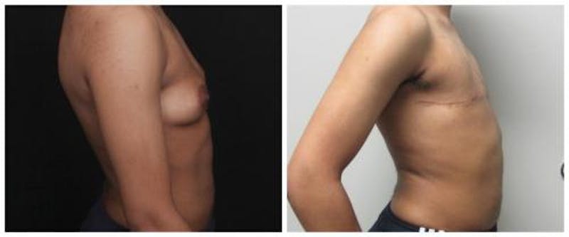 FTM Mastectomy Before & After Gallery - Patient 103688 - Image 5