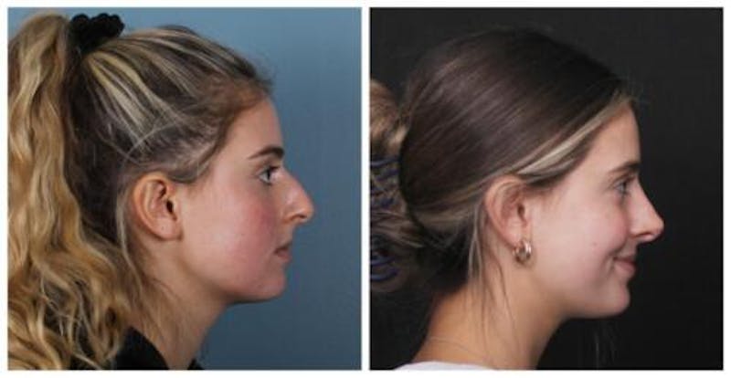 Rhinoplasty Before & After Gallery - Patient 699860 - Image 5