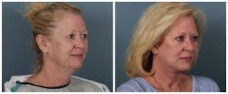 Face and Neck Lift Before & After Gallery - Patient 329341 - Image 2