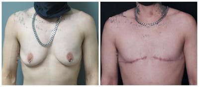 FTM Mastectomy Before & After Gallery - Patient 262507 - Image 1