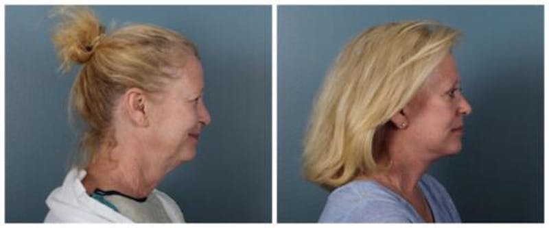 Face and Neck Lift Before & After Gallery - Patient 329341 - Image 3