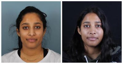 Rhinoplasty Before & After Gallery - Patient 165316 - Image 1