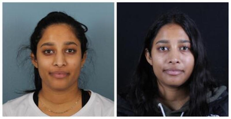 Rhinoplasty Before & After Gallery - Patient 165316 - Image 1
