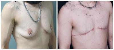 FTM Mastectomy Before & After Gallery - Patient 262507 - Image 2