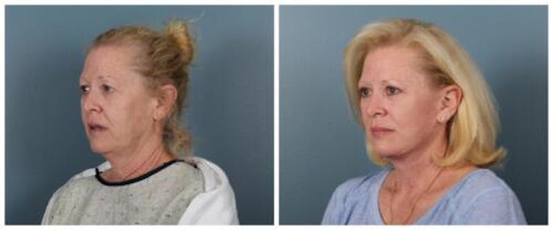 Face and Neck Lift Before & After Gallery - Patient 329341 - Image 4