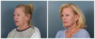 Face and Neck Lift Before & After Gallery - Patient 329341 - Image 4