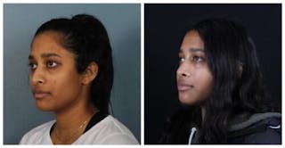 Rhinoplasty Before & After Gallery - Patient 165316 - Image 2